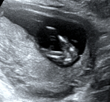 怀孕3个月有什么反应？3个月的胎儿图及孕期症状反应-第9张图片
