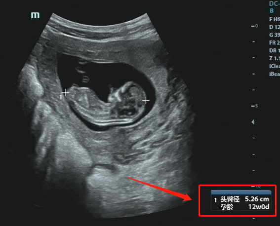 怀孕3个月有什么反应？3个月的胎儿图及孕期症状反应-第3张图片