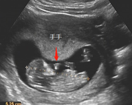 怀孕3个月有什么反应？3个月的胎儿图及孕期症状反应-第7张图片