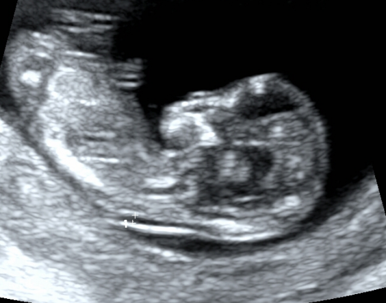怀孕3个月有什么反应？3个月的胎儿图及孕期症状反应-第11张图片