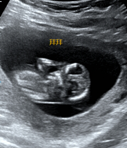 怀孕3个月有什么反应？3个月的胎儿图及孕期症状反应-第19张图片