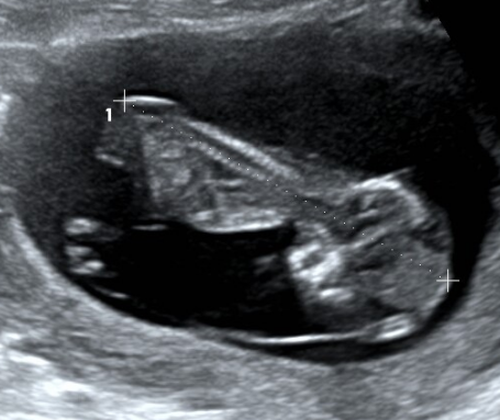 怀孕3个月有什么反应？3个月的胎儿图及孕期症状反应-第13张图片
